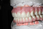 Figure 29 The buccal aspect of the maxillary and mandibular implant bridges.