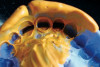 Fig 8. Mandibular arch comparing vestibular and floor of mouth depths and lateral displacement of the prosthesis.