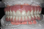 Figure 30  The completed maxillary and mandibular hybrid.