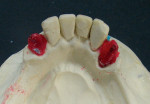 Figure 4  Mandibular master cast with resin dies for crown placement during survey, design, and fabrication of the RPD framework.