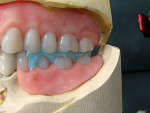 Figure 6  Left buccal view of the trimmed occlusal record—checking the cusps are fully seated.