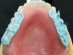 Figure 5 Occlusal view of the maxillary complete denture wax try-in with the occlusal record trimmed and placed before mounting.