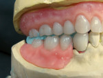 Figure 7 Right buccal view of the trimmed occlusal record for remounting and resetting occlusion of the maxillary complete and mandibular partial. Note that all the occlusal records should be trimmed so seated cusps can visually be verified.