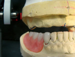 Figure 12  Maxillary edentulous ridge relationship to mandibular anterior crowns and posterior partial denture teeth. Note the minimal space and position of tuberosity to the second molar. The mandibular anteriors should have been at least 1 mm shorter to