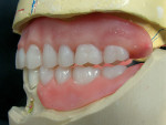 Figure 11 Checking left interocclusal space to visualize creating the curve of Spee. The distal of first and second molars need to be raised up to achieve the desired curve.
