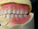 Figure 15 Left posterior view of occlusion after resetting denture teeth to a more desired curve of Spee.