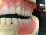 Figure 17  View of lingualized occlusion with palatal cusps lower than buccal. The distal of the maxillary second molar cannot be seen due to the curve of Spee.
