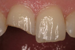 Figure 1  A clinical situation of a fractured tooth in an emergency situation. The tooth was restored on the same day following a multiple layering technique of composite resins.