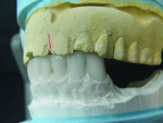 Figure 1 Diagnostic wax-up of the mandibular anteriors to the existing maxillary denture. This improper sequence created functional problems for an arrangement of new maxillary denture teeth.