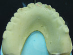 Figure 2 Occlusal view of severely worn denture teeth on existing complete maxillary denture. Note the occlusal wear patterns (reverse curve of Wilson) and chipped and broken anteriors due to guidance issues.