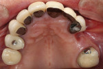 Figure 2 Preoperative occlusal view of the patient’s defective PFM restorations.