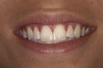 Figure 4  The diastema was closed in one appointment using composite resin. No preparation of tooth structure was required.