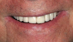 Figure 8 Postoperative view of the definitive Cercon ht zirconia restorations with the patient in natural smile.