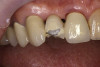 Fig 13. Mini implants with attachments in the mandible with minimal vestibular depth but adequate depth of the floor of the mouth.