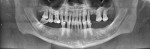 Figure 2 Pretreatment panoramic radiograph demonstrating chronic generalized periodontitis.