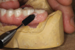 Figure 6 Application of gingival composite paste.