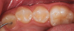 Figure 1 Preoperative photograph of tooth No. 28.
