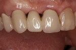 Figure 6  Using a combination of composite materials, a cost-effective bridge repair was completed in one appointment.