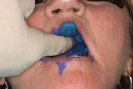 Figure 6 Maxillary impression in place and held securely through setting time.