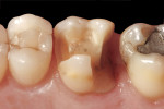 Figure 2  Existing amalgam restoration was removed, and remaining tooth structure was prepared to receive a MODL e.max Press monolithic onlay restoration.