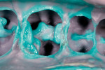 Figure 3  Intraoral PVS impression was made of the MODL onlay preparation.