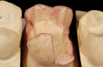 Figure 4  Gypsum stone die poured and trimmed in the dental laboratory.