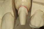 Figure 11  After core reconstruction and crown preparation, PVS impression was made and a gypsum die was constructed. A 135-degree angulation shoulder preparation finish line was created for tooth No. 11.