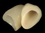 Figure 12  Lithium-disilicate crown was waxed, invested, pressed, devested, contoured, and extrinsically stained-fired in several layers to achieve proper shade.