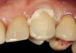 Figure 13  Tooth preparation was conditioned with appropriate bonding protocol, and definitive crown cemented with dual-cure resin cement.