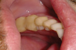 Figure 7 Fixed bonding was placed on the posteriors to increase the patient’s vertical dimension and reduce occlusal irregularities.
