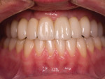 Figure 18 Once tried in, the value of the upper is noticeably lower than the natural mandibular anteriors.