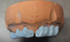 (27.) Silver modified atraumatic restorative technique (SMART) caries control treatment demonstrated on extracted carious primary molar.