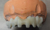 (29.) Silver modified atraumatic restorative technique (SMART) caries control treatment demonstrated on extracted carious primary molar.