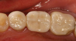 Figure 4  Example of one of the two posterior bridges that experienced porcelain chipping during the course of this study.