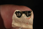 Figure 14 The gingival silhouette of the wax over the implants was scored into the stone and with a sharp blade over a very fine red pencil.