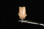 Figure 15 A wax-up was completed on the titanium abutment base. The wax-up replicated the shape of the area where the initial full-contour wax-up contacted the tissue.