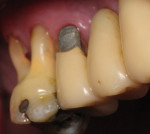 Figure 2  Class V amalgam restoration on tooth No. 4 associated with plaque-induced gingivitis in a patient with poor oral hygiene.
