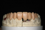 Figure 20 A matrix is used to recreate the full-contour wax-up over the IPS e.max abutments.