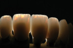 Figure 26 The internal effects and natural opalescence of the lithium disilicate restorations were clearly visible when backlit.