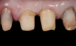 Figure 30 The abutments esthetically matched the natural tooth structure.