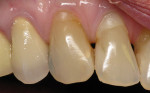 Figure 4  Facial Class V composite on tooth Nos. 6 and 7 in a patient with excellent home care. Note the healthy gingiva adjacent to restorations even with the bulky restoration on tooth No. 7.