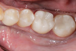 Figure 3 - With the combination of composite resin (IPS Empress Direct and Tetric Evo Ceram Bulk Fill) and IPS e.max lithium disilicate, there is now an excellent alternative for everyday dentistry.