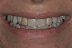 Figure 1 - This patient presented with discolored direct composite veneers on teeth Nos. 7 and 10. The treatment plan included porcelain laminates on teeth Nos. 6, 7, and 10, along with selective enameloplasty on teeth Nos. 5, 8, and 9.