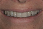 Figure 3 - This patient presented with discolored direct composite veneers on teeth Nos. 7 and 10. The treatment plan included porcelain laminates on teeth Nos. 6, 7, and 10, along with selective enameloplasty on teeth Nos. 5, 8, and 9.