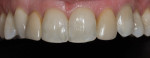 Figure 2 - This patient presented with discolored direct composite veneers on teeth Nos. 7 and 10. The treatment plan included porcelain laminates on teeth Nos. 6, 7, and 10, along with selective enameloplasty on teeth Nos. 5, 8, and 9.
