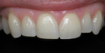 Figure 6 - This patient presented with enamel wear, chipping on the incisors, and a PFM restoration with a discolored margin on tooth No. 9. The patient was pleased with the enameloplasty on the central and laterals and a Lava crown on tooth No. 9.