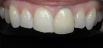 Figure 5 - This patient presented with enamel wear, chipping on the incisors, and a PFM restoration with a discolored margin on tooth No. 9. The patient was pleased with the enameloplasty on the central and laterals and a Lava crown on tooth No. 9.