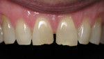 Figure 7 - This patient’s worn and chipped incisors with a diastema were treated by placing laminates on teeth Nos. 8 and 9 and bonding teeth Nos. 7 and 10 to enhance their appearance and restore the teeth.