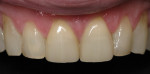 Figure 8 - This patient’s worn and chipped incisors with a diastema were treated by placing laminates on teeth Nos. 8 and 9 and bonding teeth Nos. 7 and 10 to enhance their appearance and restore the teeth.