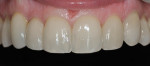 Figure 4 - This patient presented with discolored direct composite veneers on teeth Nos. 7 and 10. The treatment plan included porcelain laminates on teeth Nos. 6, 7, and 10, along with selective enameloplasty on teeth Nos. 5, 8, and 9.